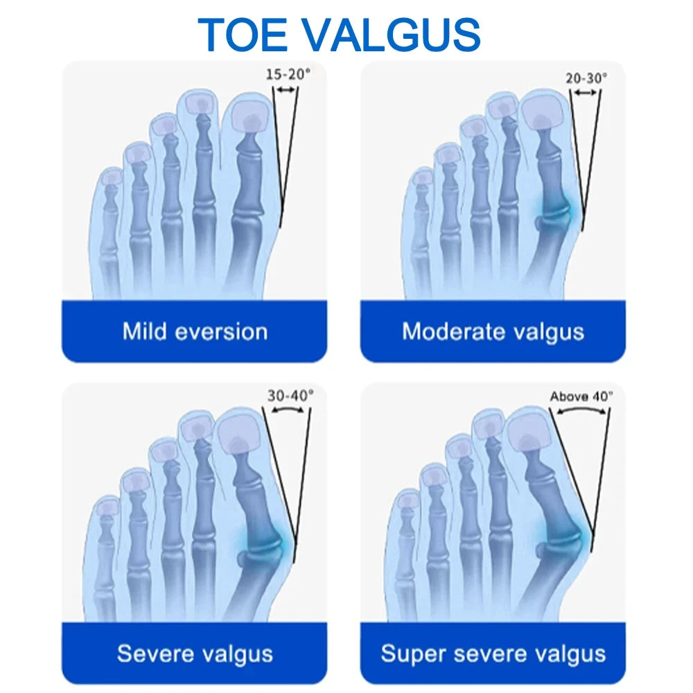 Big Toe Bunion Splint